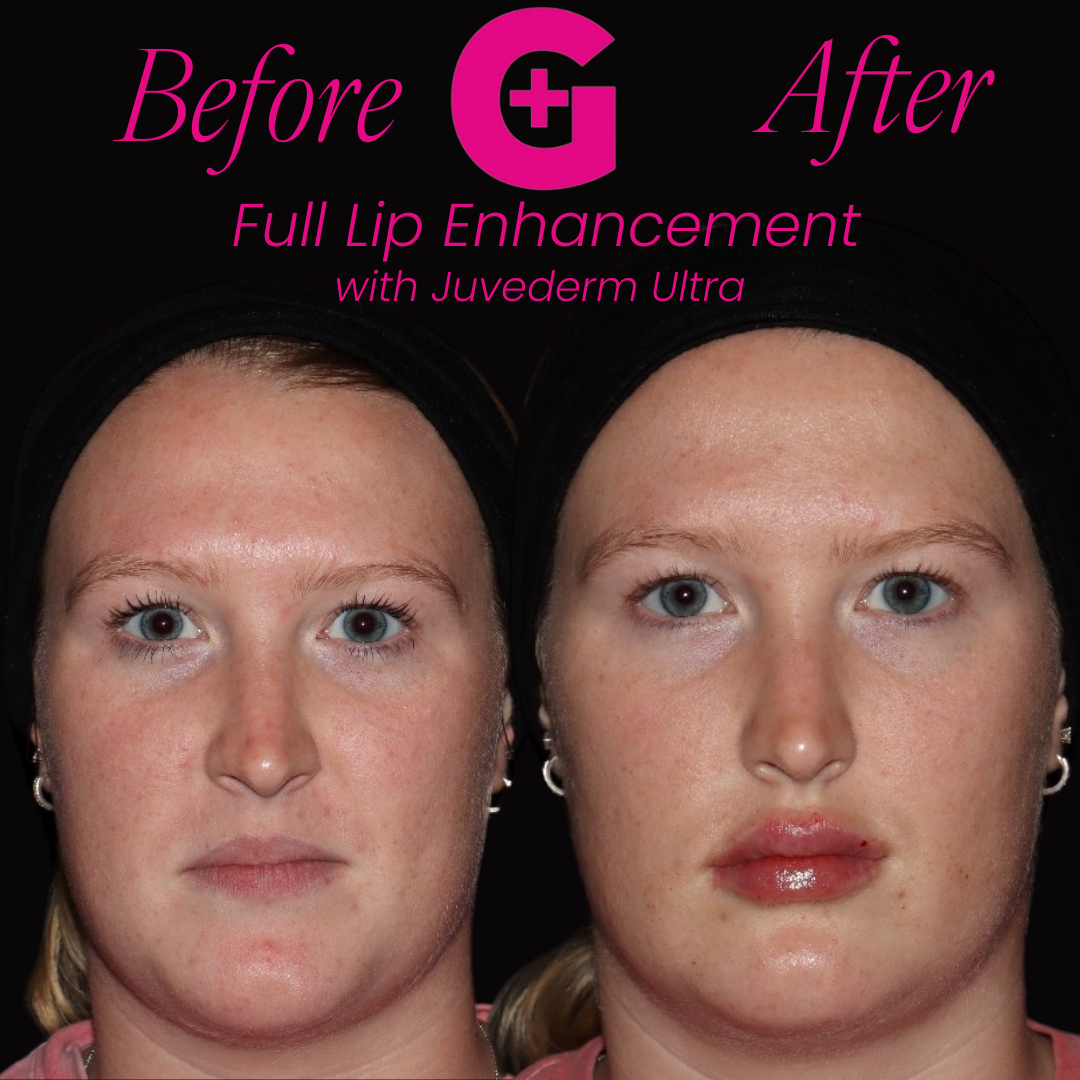 lip filler b and a