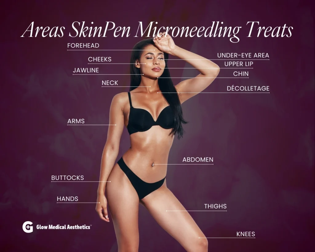 Areas SkinPen Microneedling Treats