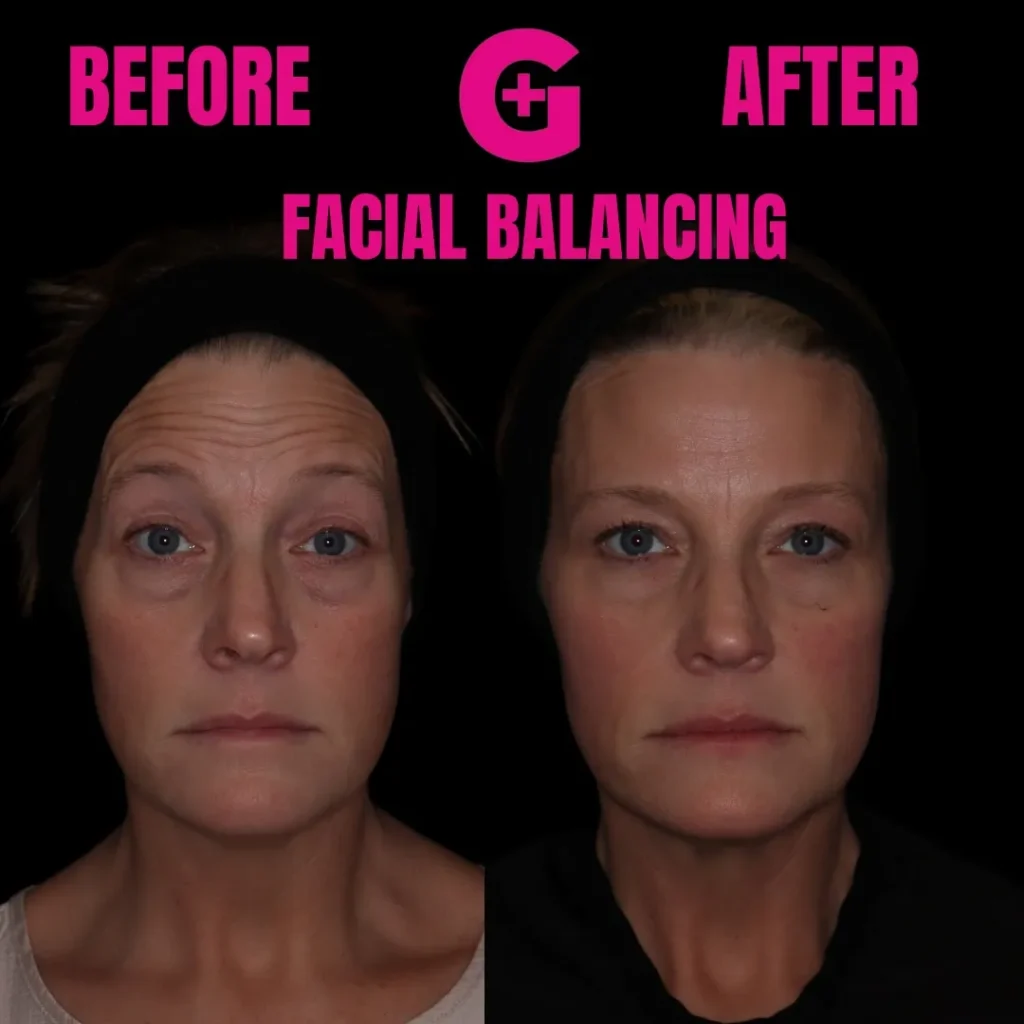 Facial Balancing - Before and After