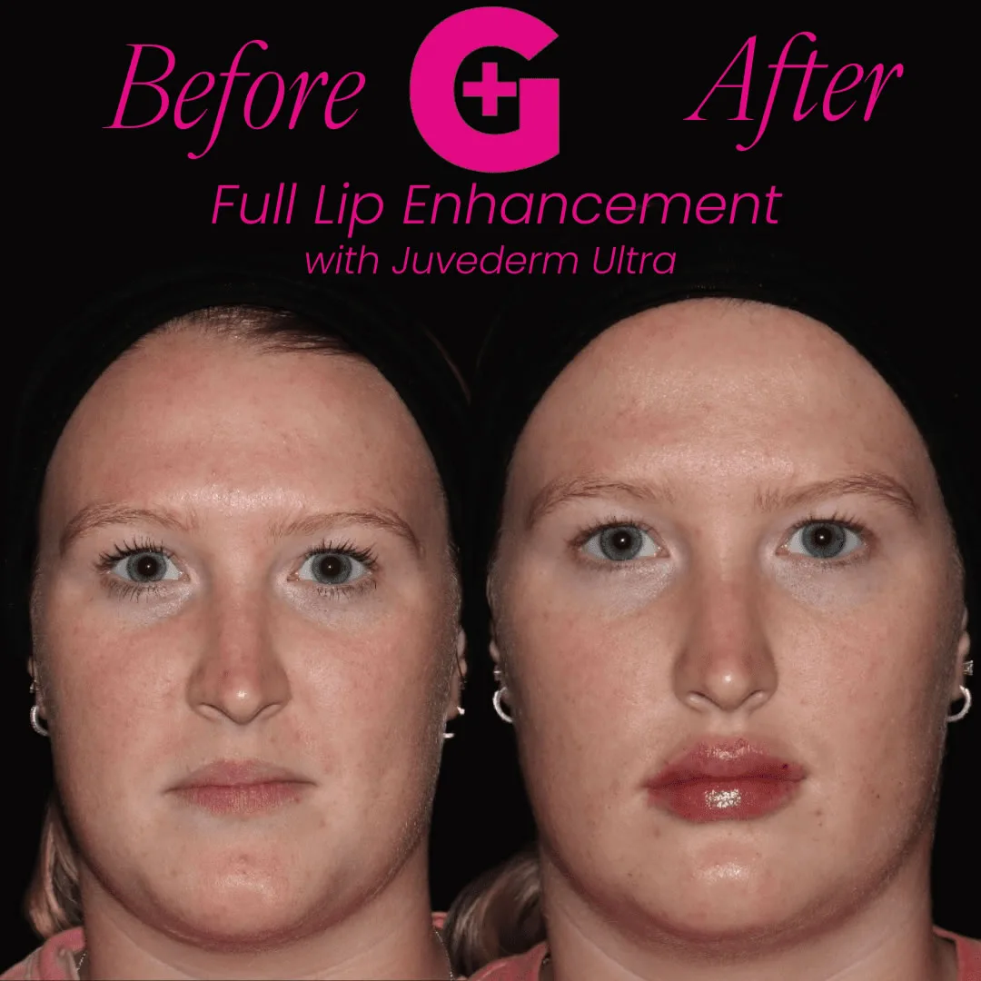 lip-filler-b-and-a